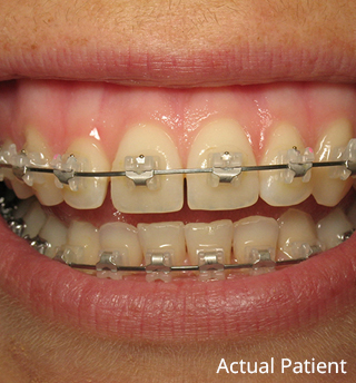passage pain Hesitate Clear Braces - Brazeau Orthodontics | Wenatchee Chelan WA