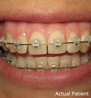 Ceramic Braces  Clear Orthodontic Options